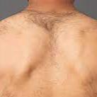 Shoulder Laser Hair Removal (Package of 8)