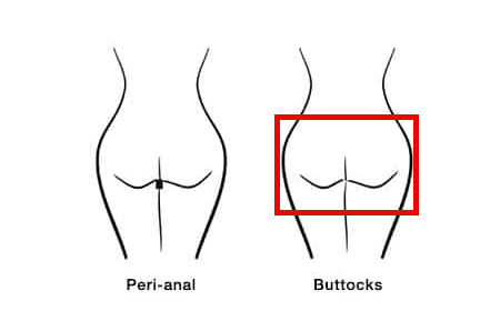 Buttocks Laser Hair Removal (Package of 8)