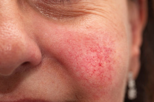 Diffuse Redness Session