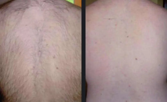 Full Back Laser Hair Removal (Package of 8)